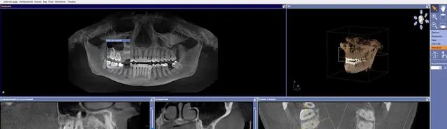 Томограф Sirona Galileos Compact FoV 15×15
